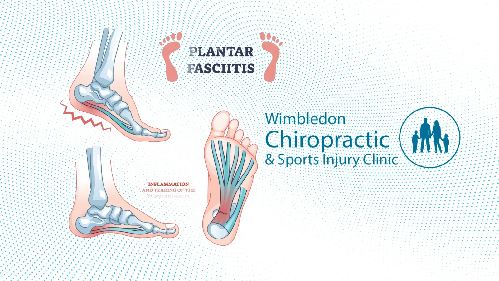 heel pain treatment wimbledon SW19 - Focused shock wave therapy wimbledon SW19