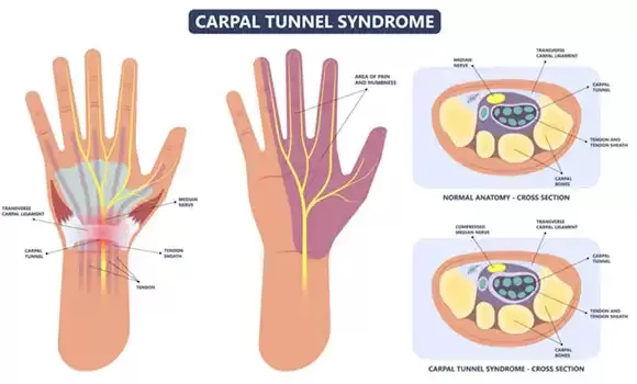 True Carpal Tunnel Syndrome vs. Double Crush Syndrome