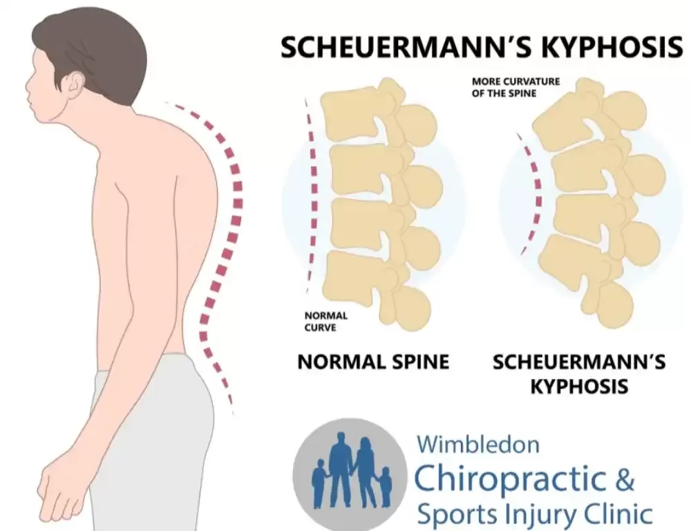 Pathophysiology of Scheuermann Kyphosis