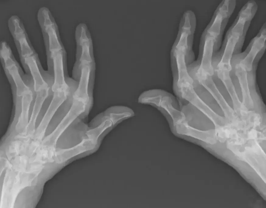 Chiropractic Joint Mobilization of the Hands of Patients With Rheumatoid Arthritis: Insights from a Groundbreaking Study