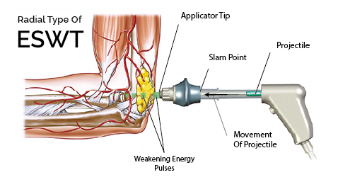 how radial eswt applicators work